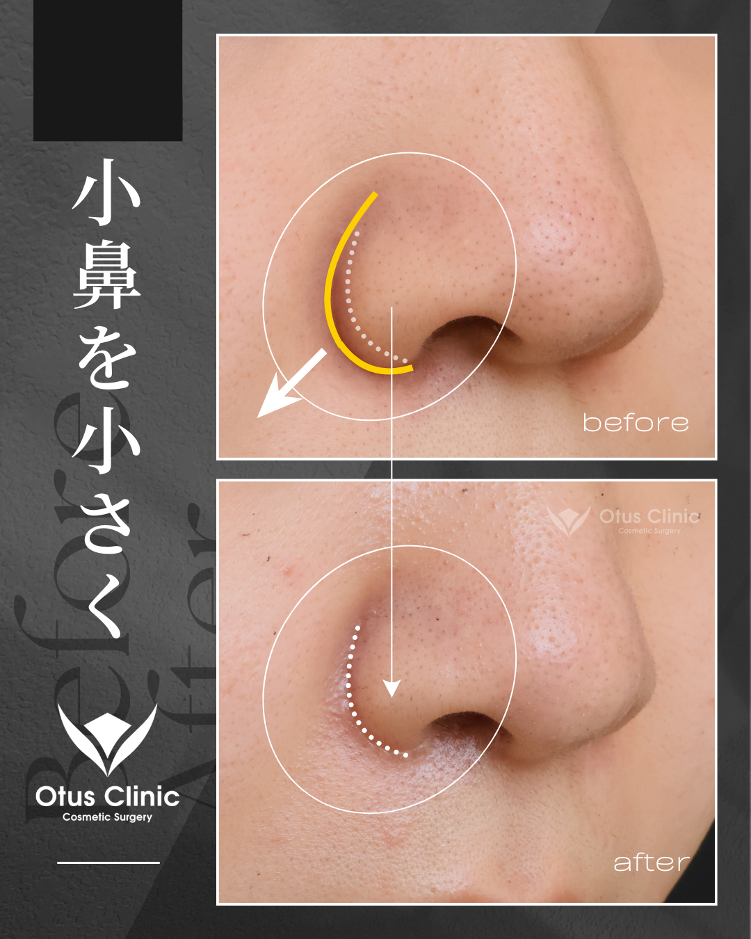 鼻翼縮小・鼻翼挙上・鼻柱切開人中短縮