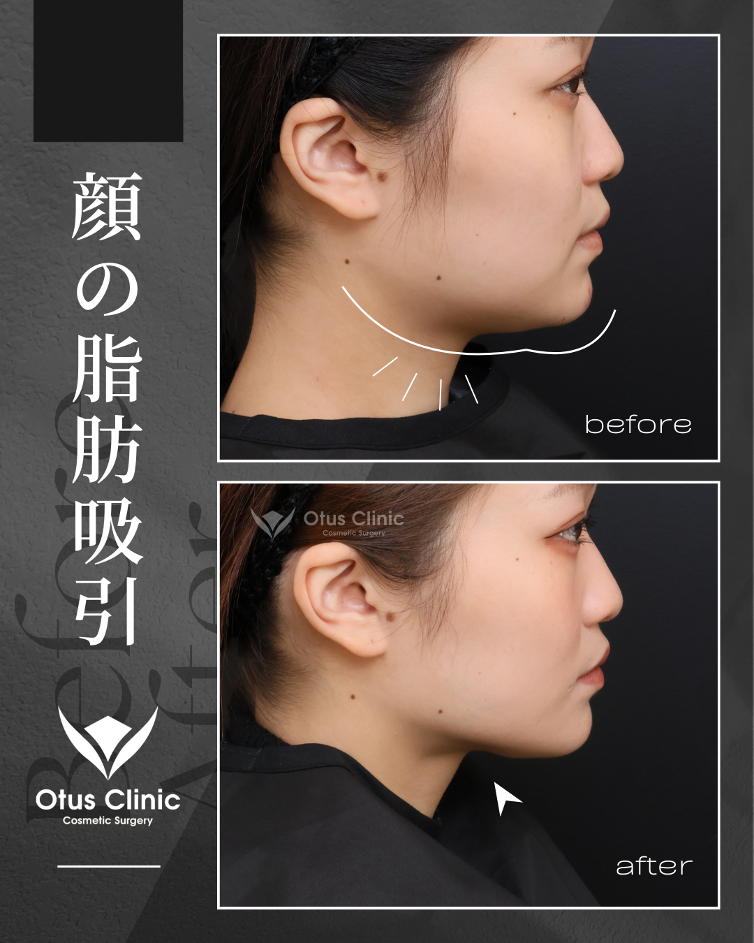 頬顎下脂肪吸引 ・ジョールファット除去 ・ エラBTX