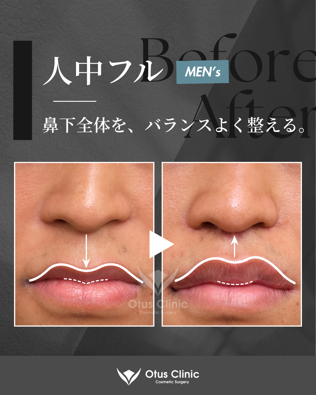 人中フル（人中短縮 / 鼻翼縮小 / 鼻翼挙上 / 外側人中短縮 / 口角挙上）・M字リップ ・貴族組織移植