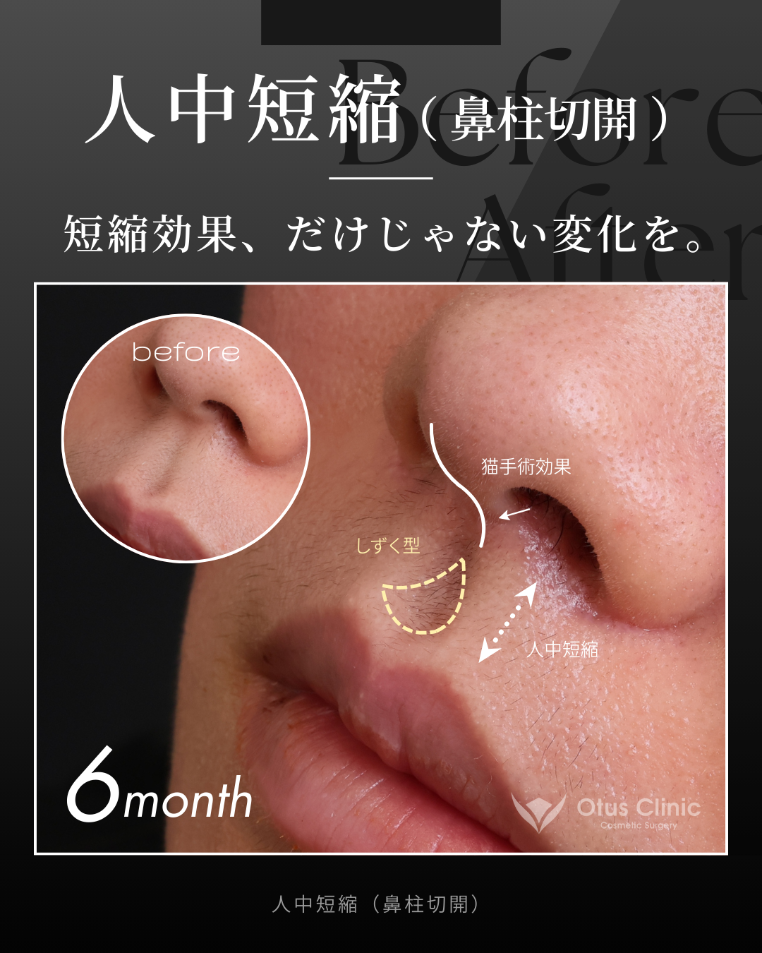鼻柱切開人中短縮