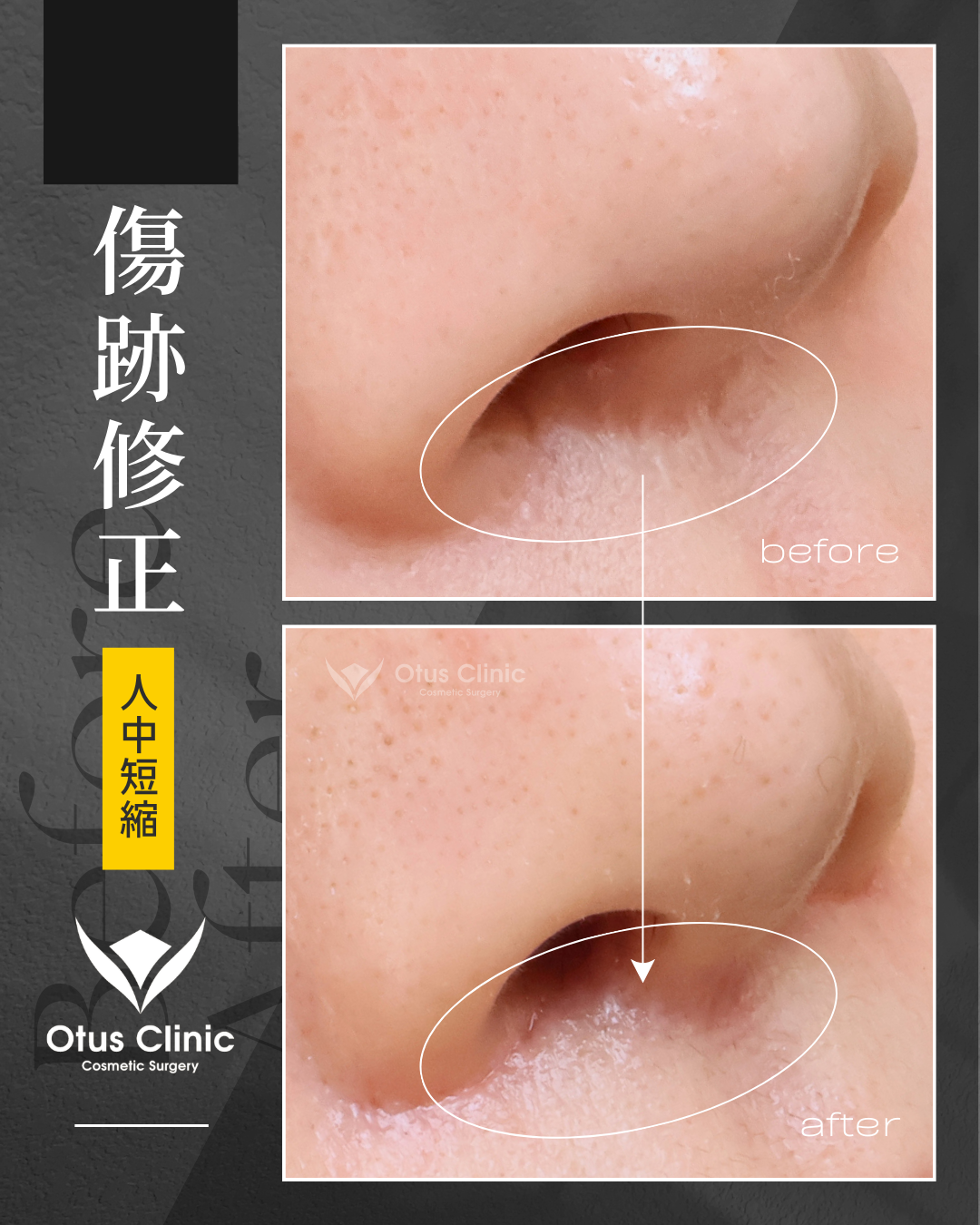 【他院修正】鼻柱切開人中短縮・鼻翼縮小・鼻翼挙上