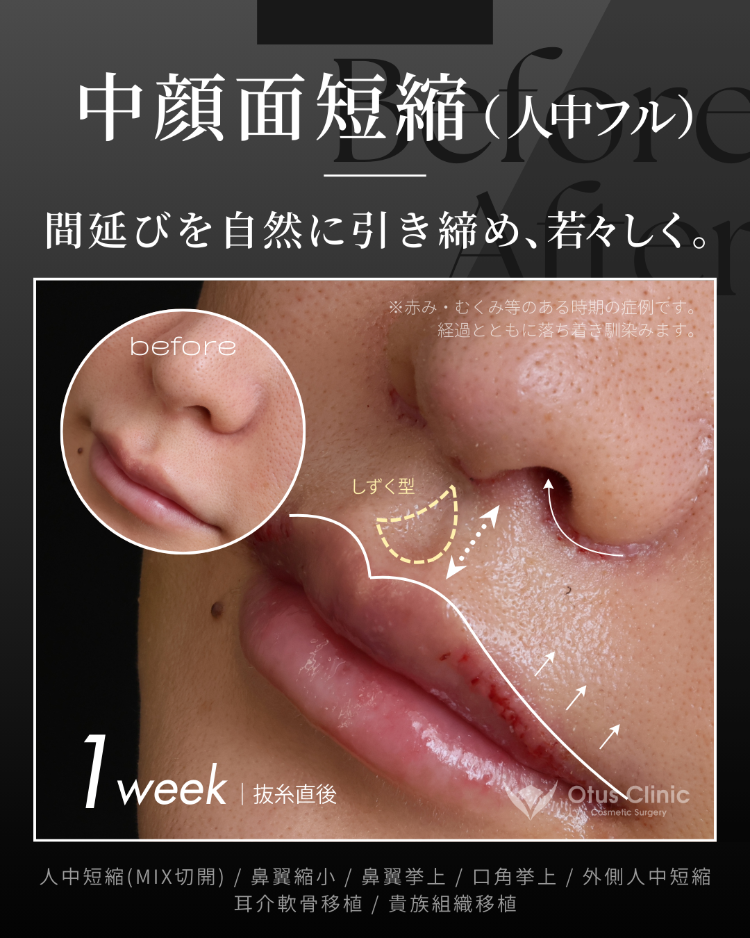 人中短縮(鼻柱切開×鼻孔内切開)・鼻翼縮小・鼻翼挙上・口角挙上・外側人中短縮・貴族組織移植・耳介軟骨移植