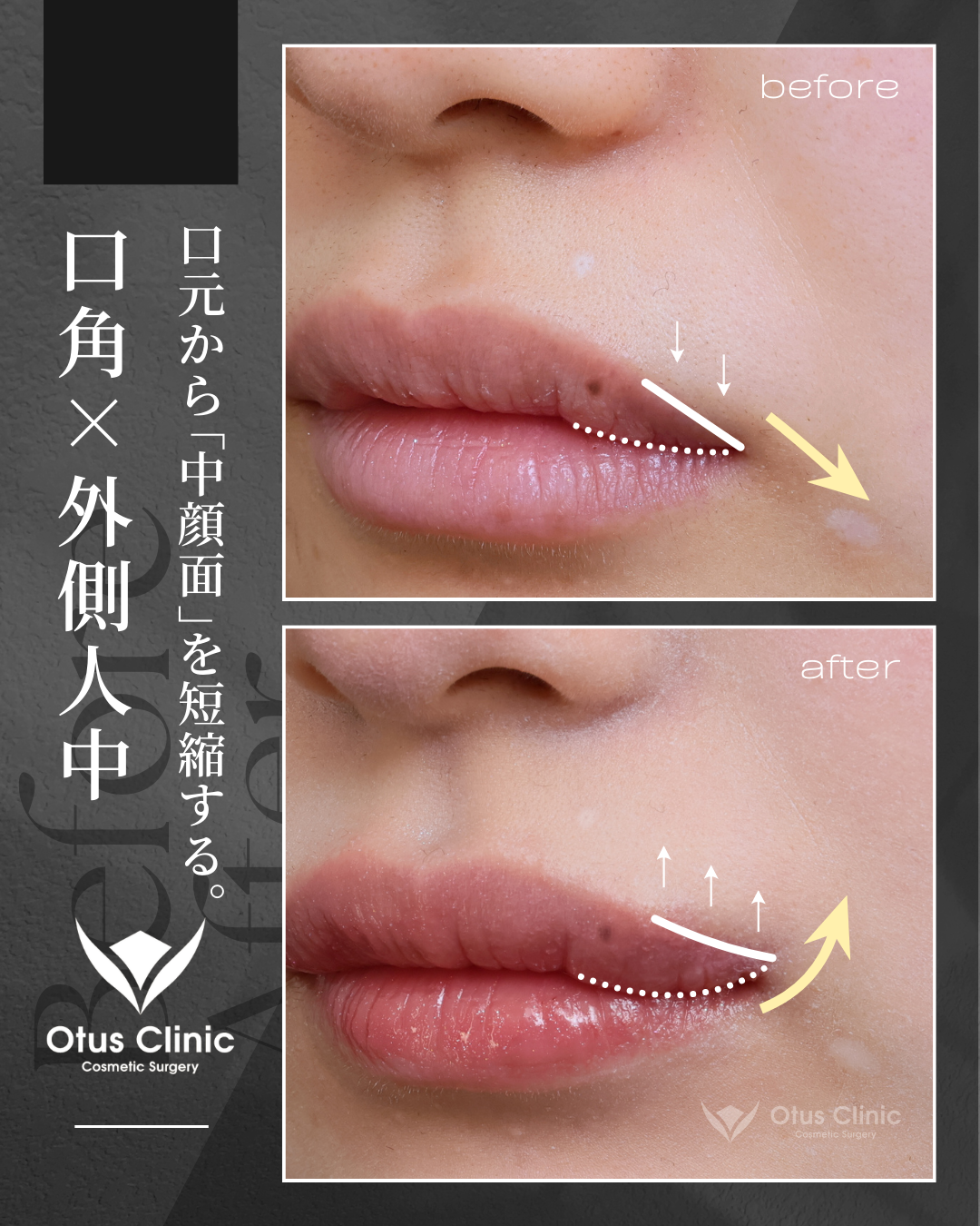 口角挙上・外側人中短縮