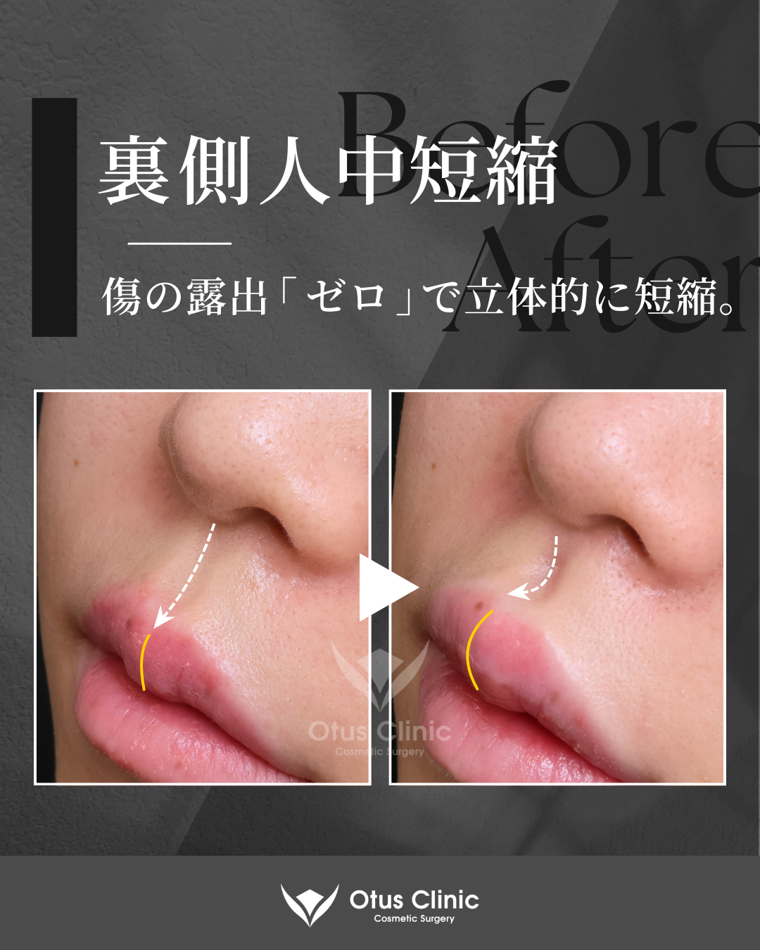 裏側人中短縮（切らない人中短縮）・裏側鼻翼縮小（切らない小鼻縮小）