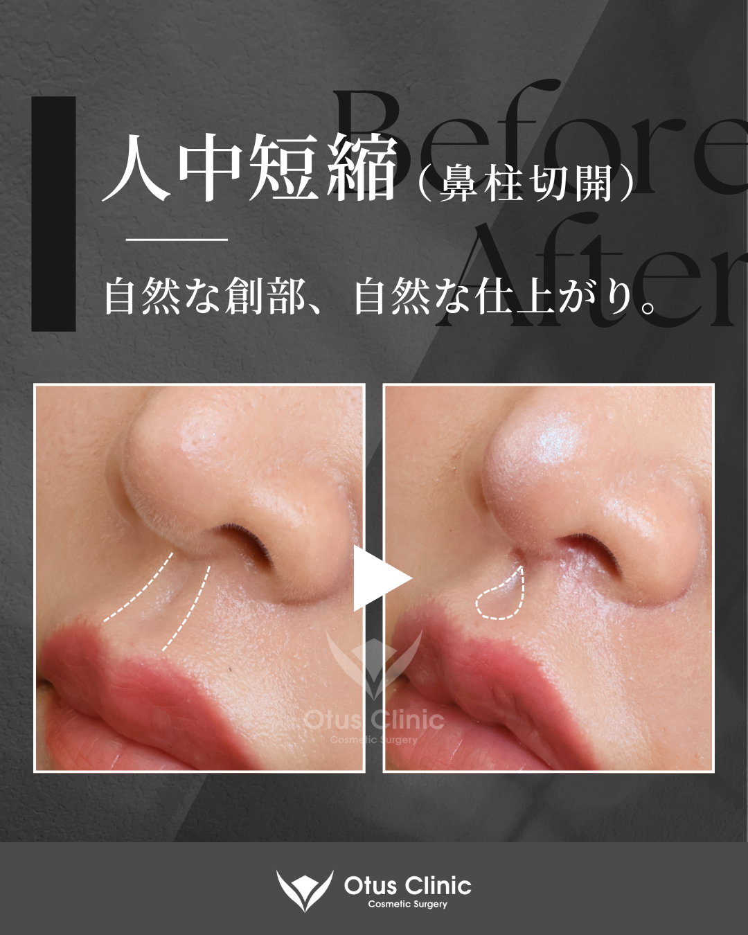 鼻柱切開人中短縮・貴族組織移植・鼻翼縮小・鼻翼挙上