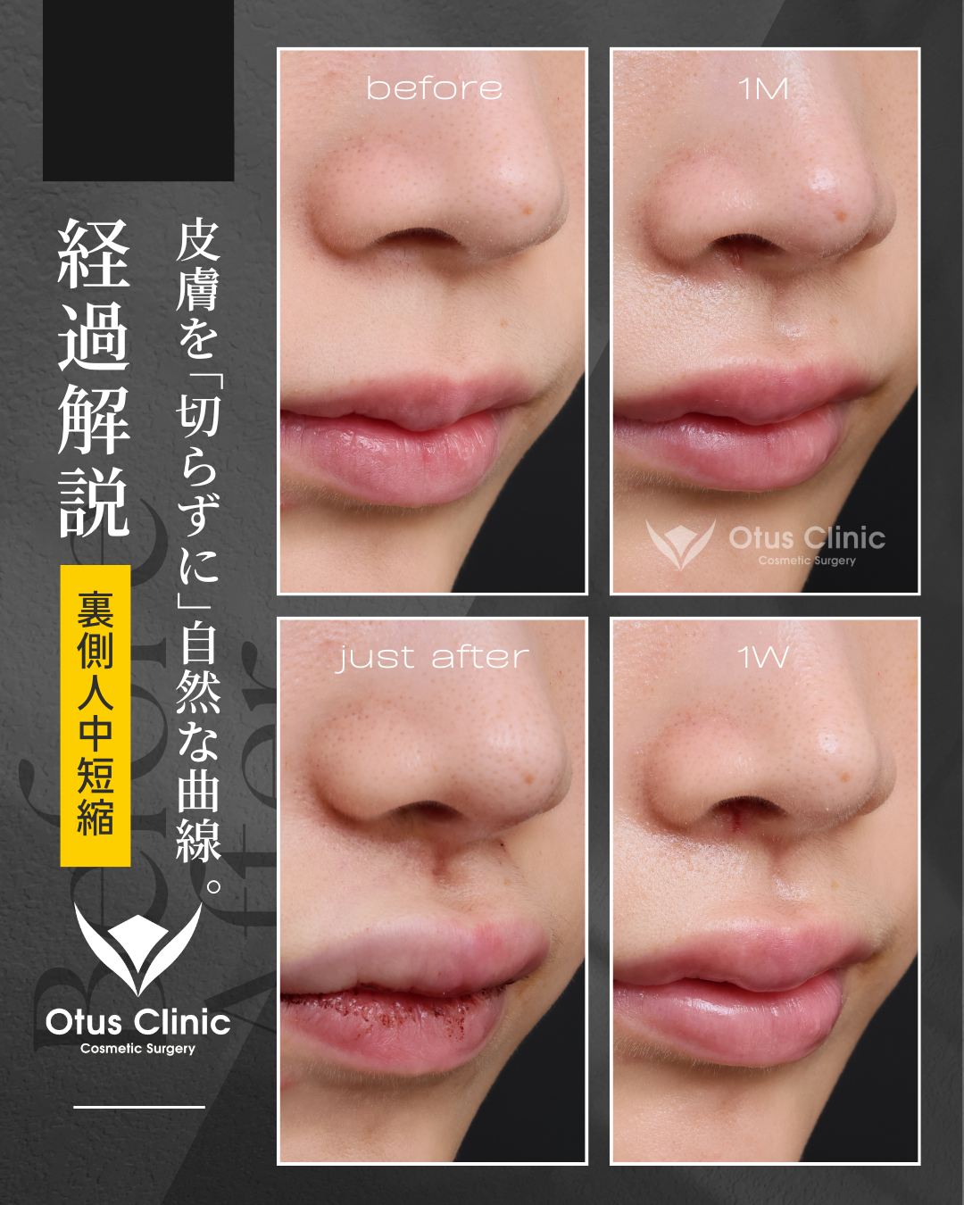 裏側人中短縮（切らない人中短縮）