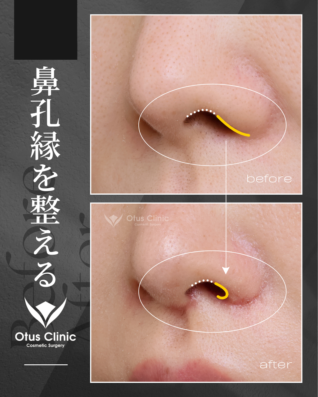 人中短縮(鼻柱切開×鼻腔内切開)・鼻翼縮小・鼻翼挙上・鼻孔縁挙上・クロス組織移植