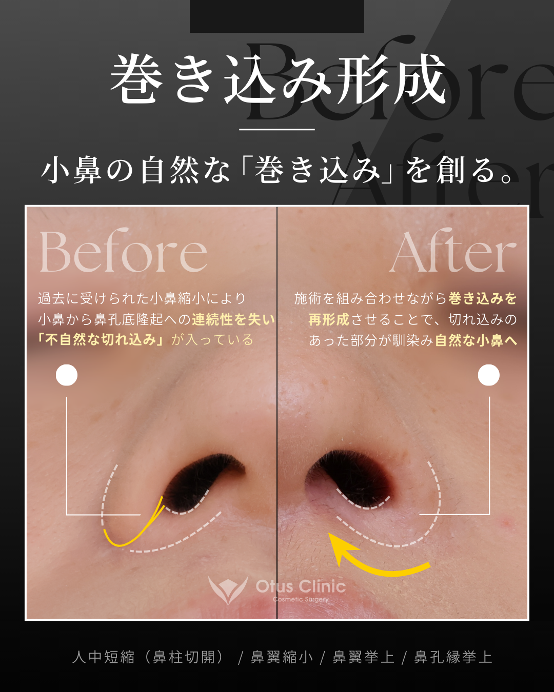 鼻柱切開人中短縮・鼻翼縮小・鼻翼挙上・鼻孔縁挙上