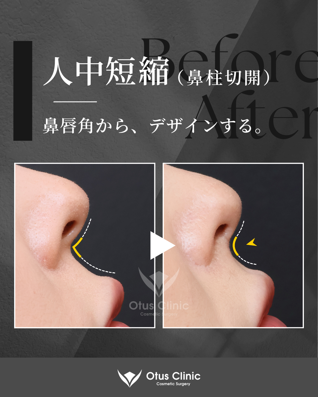 鼻柱切開人中短縮・鼻翼縮小・鼻翼挙上