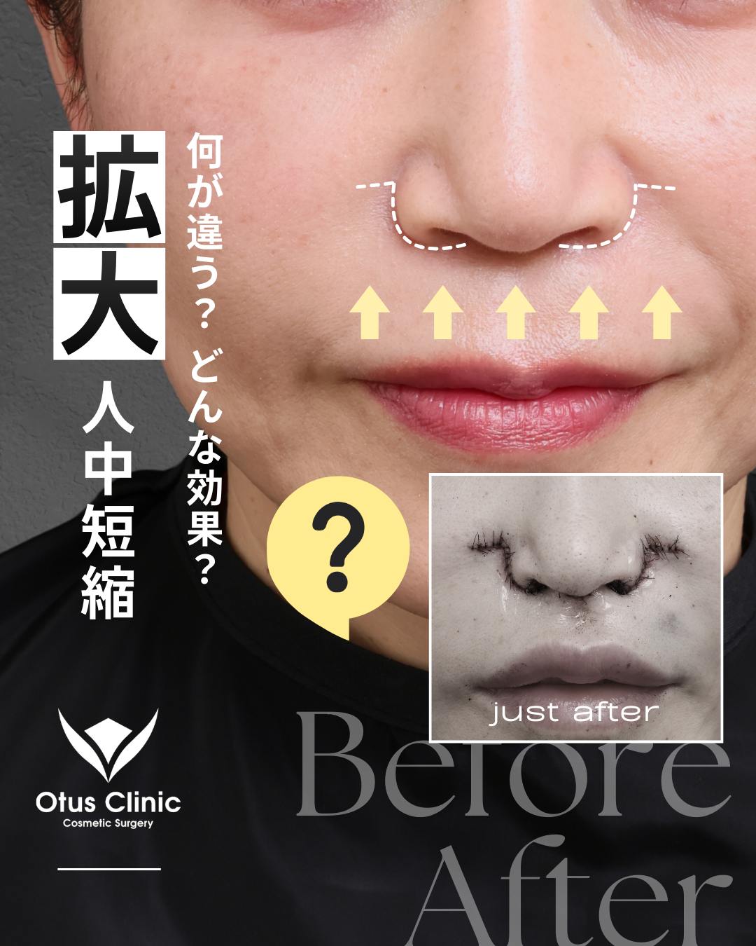 拡大人中短縮（MIX切開）/ 鼻翼縮小 / 鼻翼挙上 / 鼻孔縁挙上