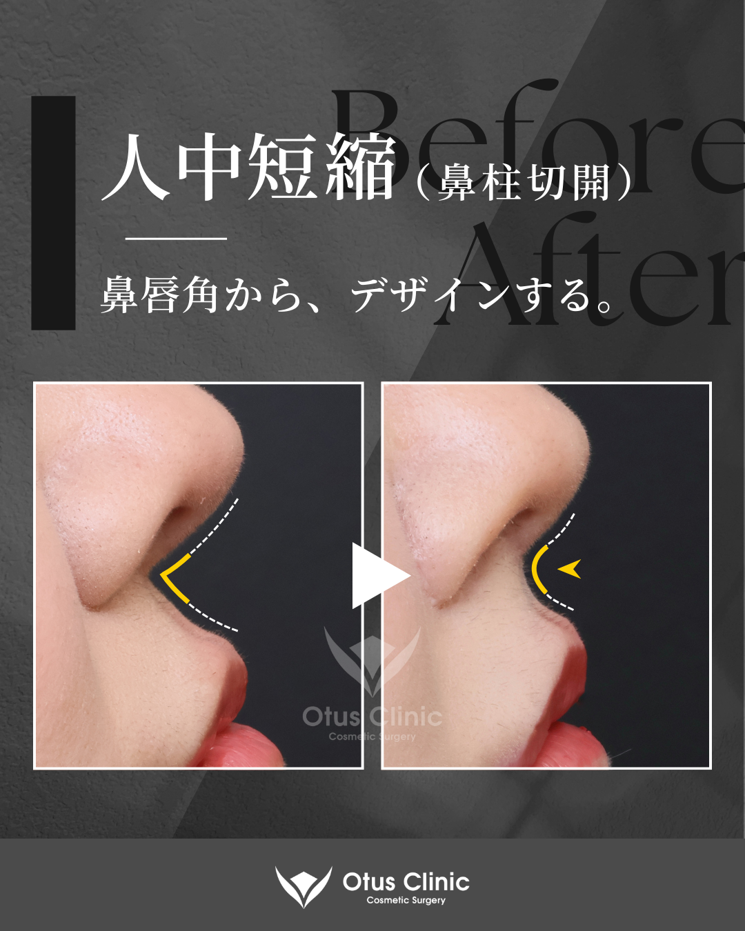 鼻柱切開人中短縮・鼻翼縮小・鼻翼挙上・口角挙上・外側人中短縮 ・鼻孔縁挙上