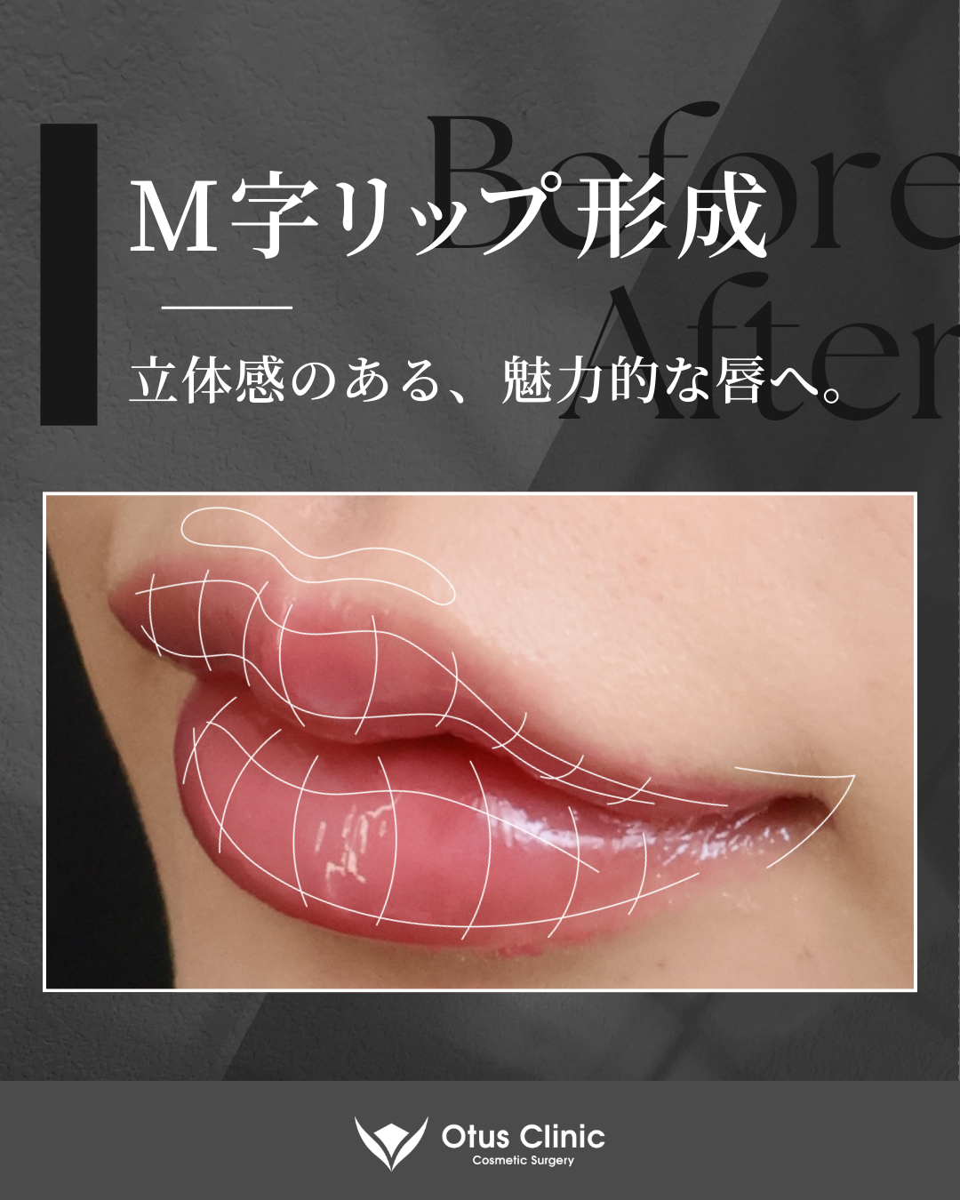 M字リップ ・鼻孔縁挙上 ・人中フル（人中短縮 / 鼻翼縮小 / 鼻翼挙上 / 外側人中短縮 / 口角挙上）