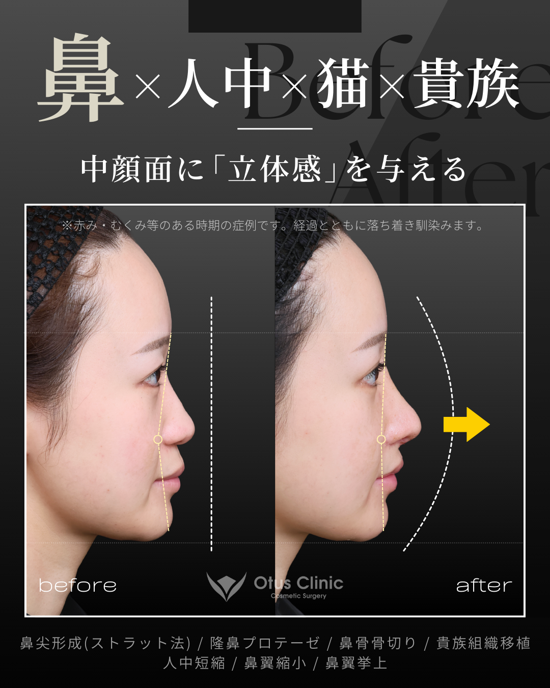 鼻尖形成(耳介軟骨移植つき)・ストラット法・隆鼻プロテーゼ・鼻骨骨切り・貴族組織移植・鼻柱切開人中短縮・鼻翼縮小・鼻翼挙上