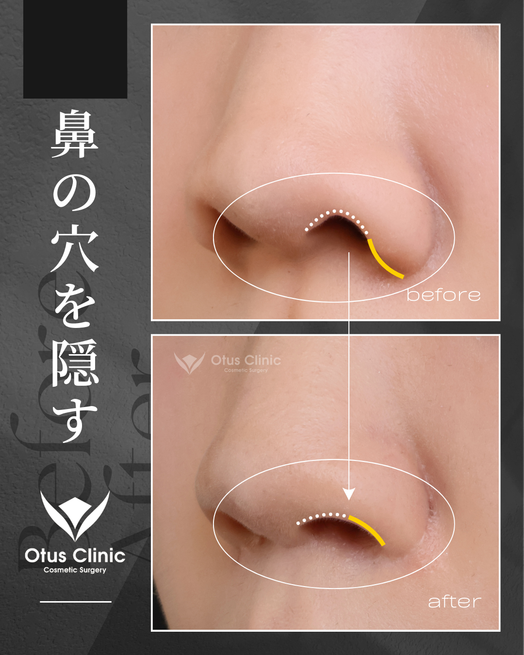 人中短縮・鼻翼縮小・鼻翼挙上・鼻孔縁下降・鼻孔縁挙上