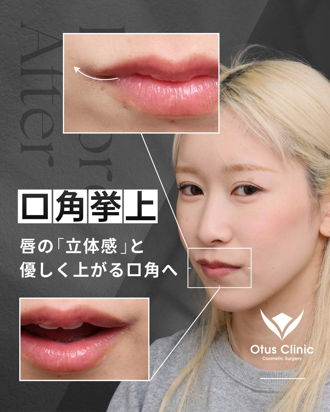 口角挙上（全層法）・外側人中短縮・M字リップ