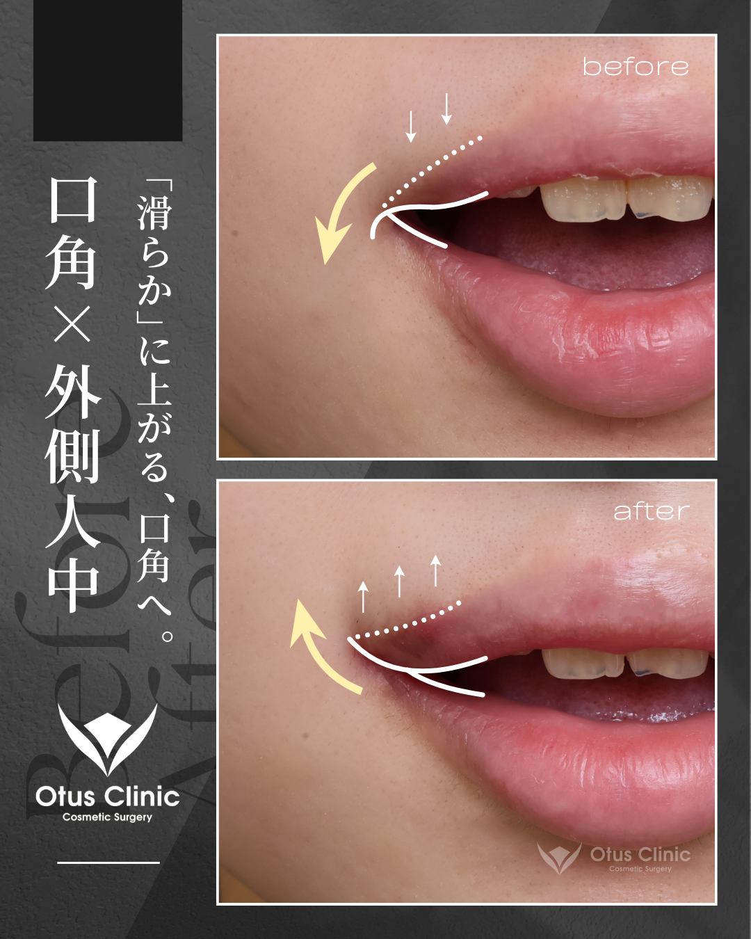 口角挙上（全層法）・外側人中短縮