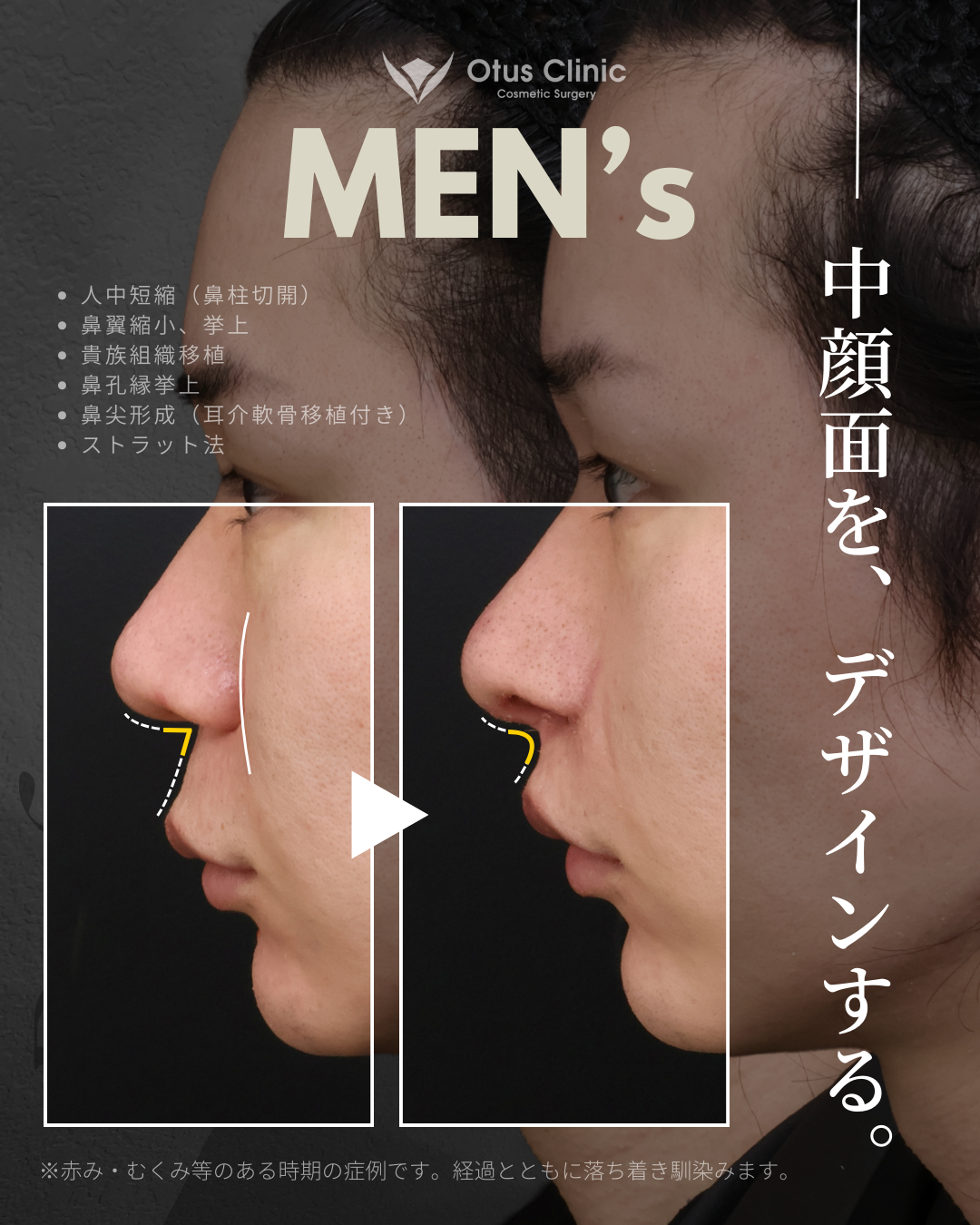 鼻柱切開人中短縮・鼻翼縮小・鼻翼挙上・貴族組織移植・鼻孔縁挙上 ・鼻尖形成（耳介軟骨移植付き）・ストラット法