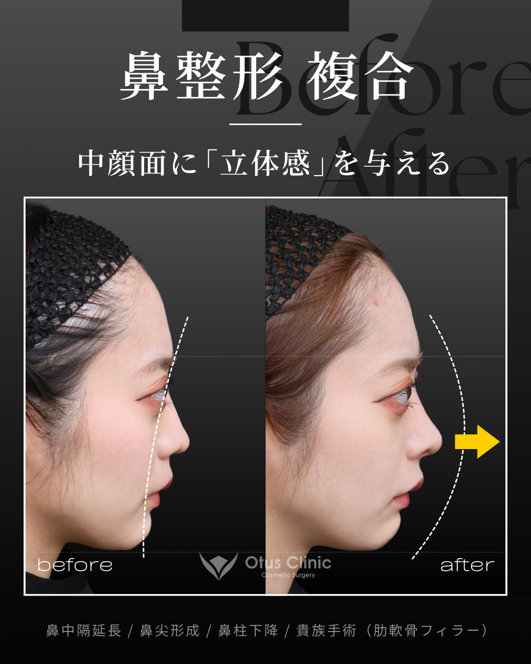 鼻中隔延長（肋軟骨）・鼻尖形成・鼻柱下降・貴族手術（肋軟骨フィラー）