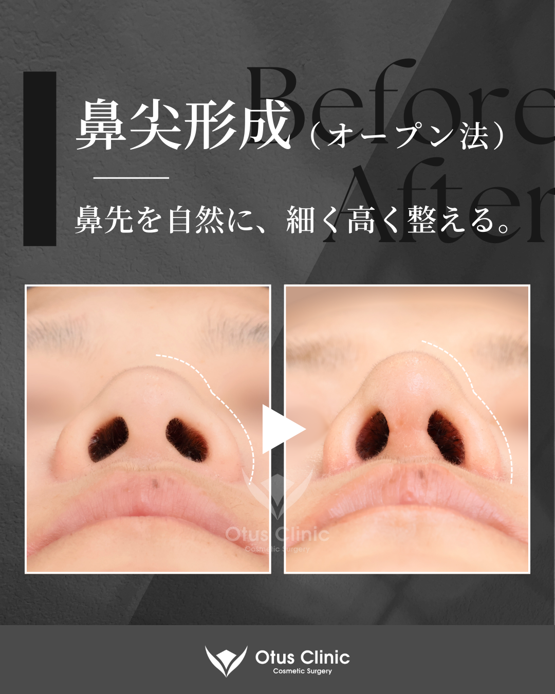 鼻尖形成（耳介軟骨移植付き）・鼻翼縮小