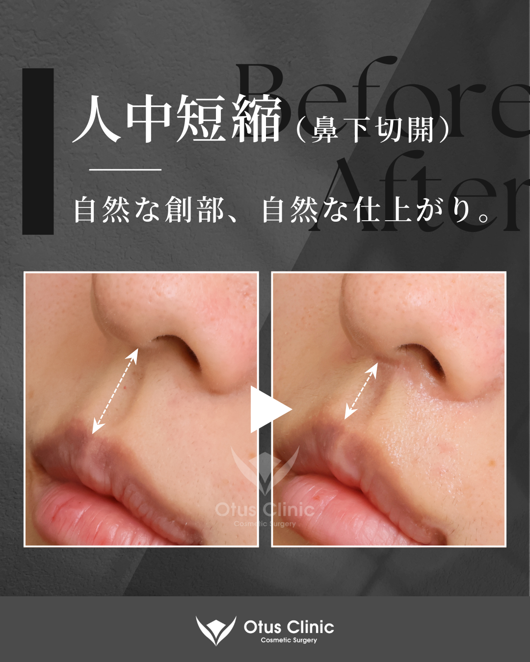 人中短縮(鼻下切開)