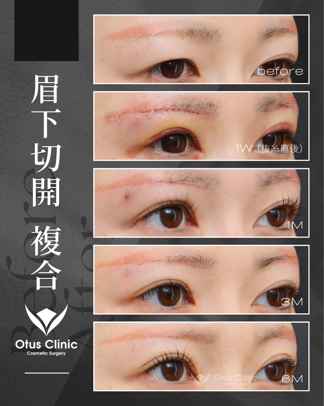 眉下切開・ROOF切除・眼窩脂肪移動