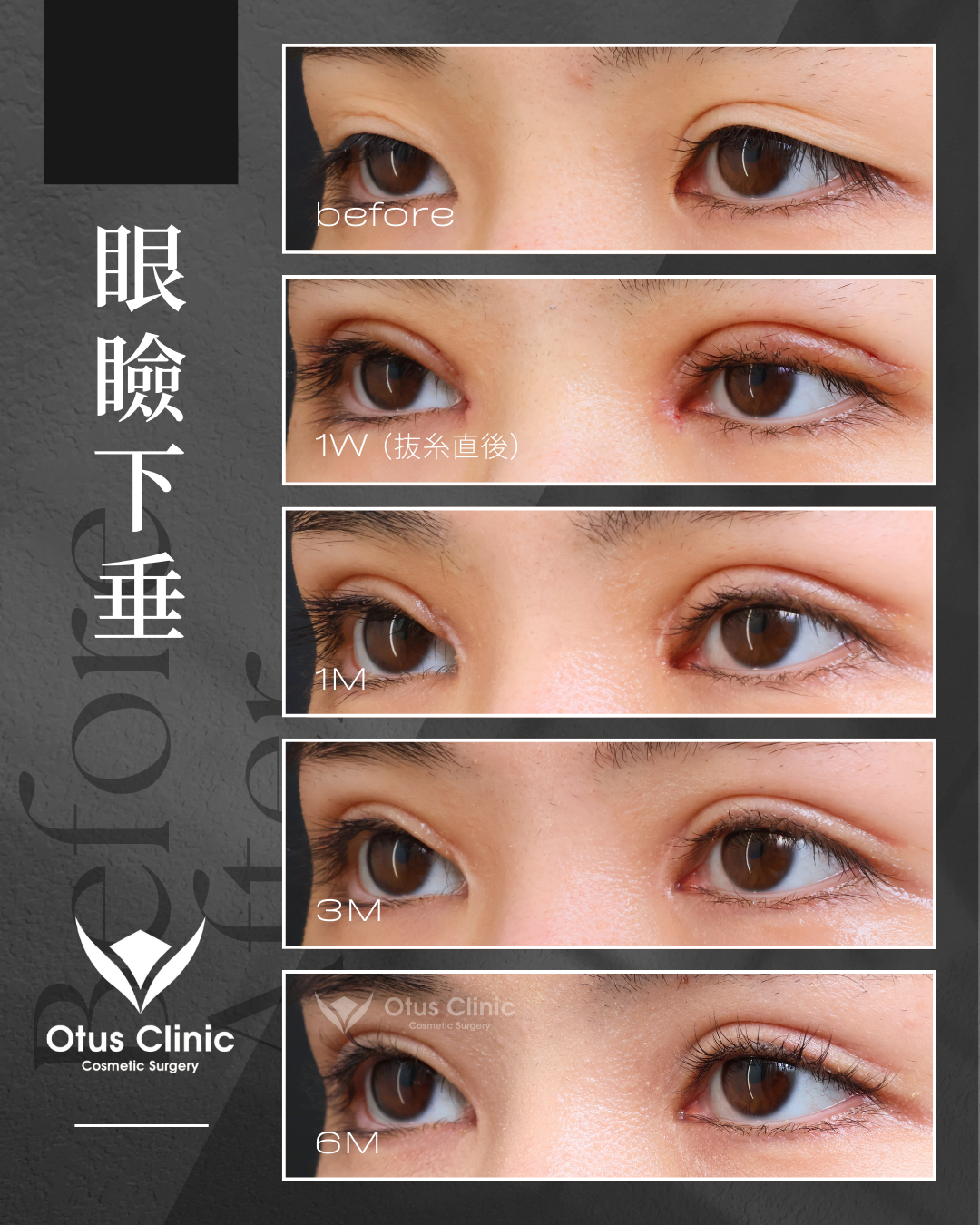 眼瞼下垂・目頭切開