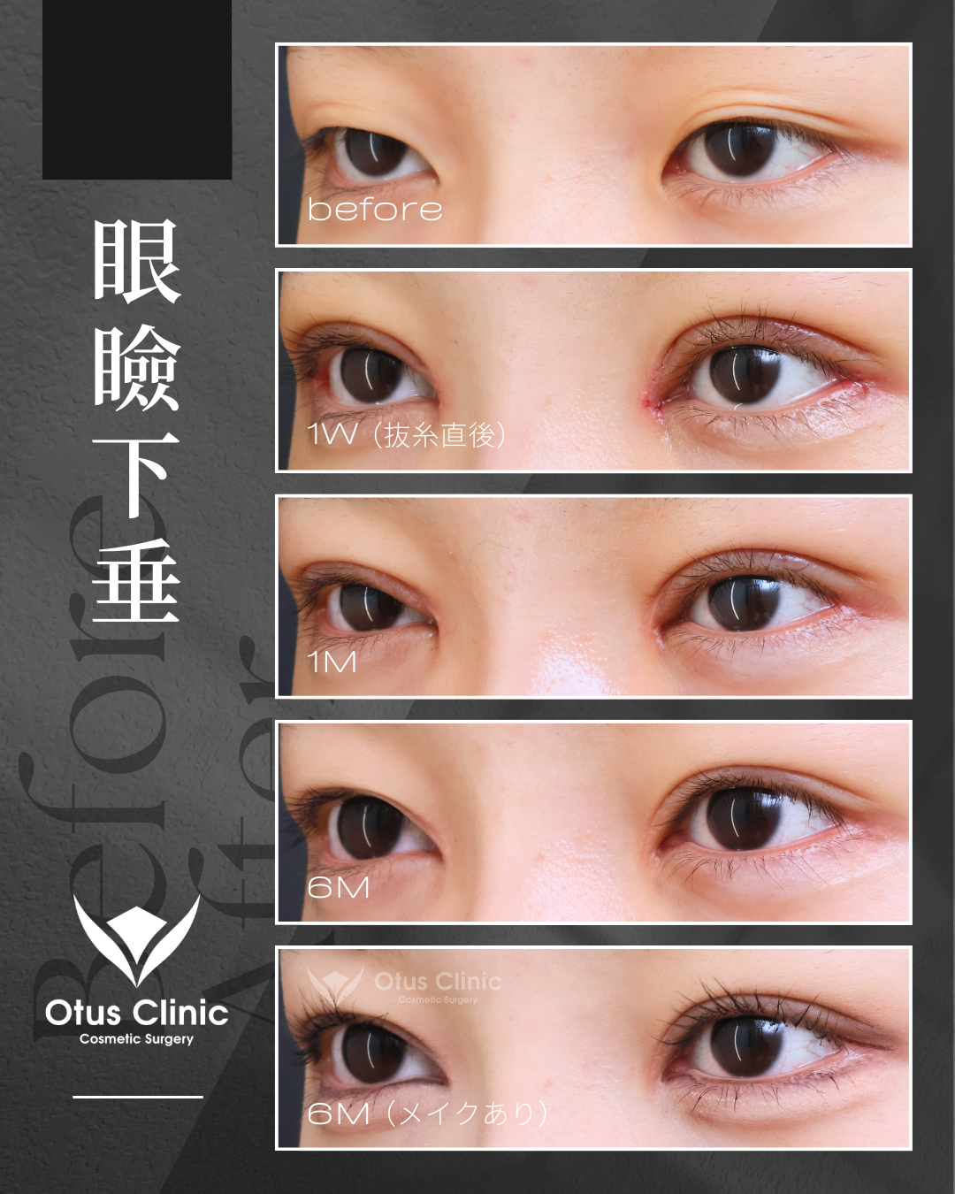 眼瞼下垂・目頭切開・目尻切開