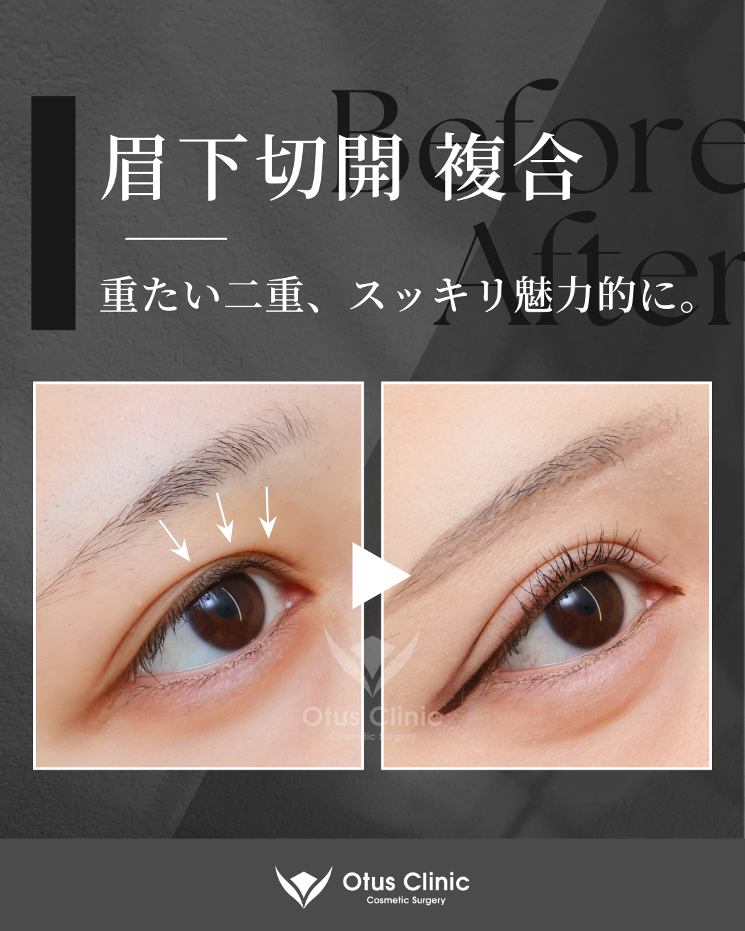 眉下切開・ROOF切除・眼窩脂肪移動