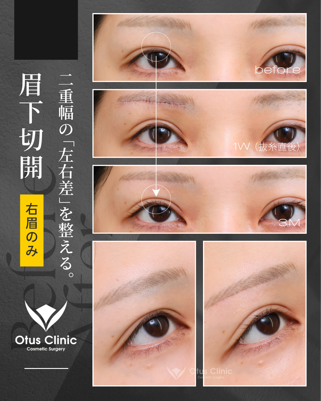 眉下切開（右のみ）