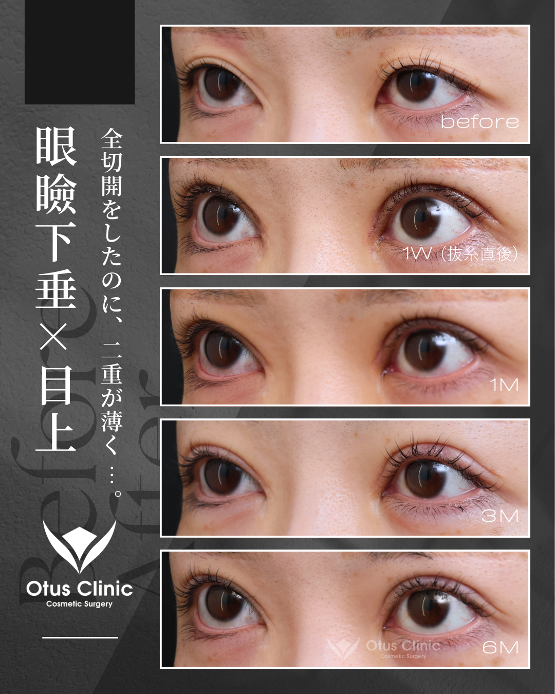 眼瞼下垂（挙筋前転法）・目上切開