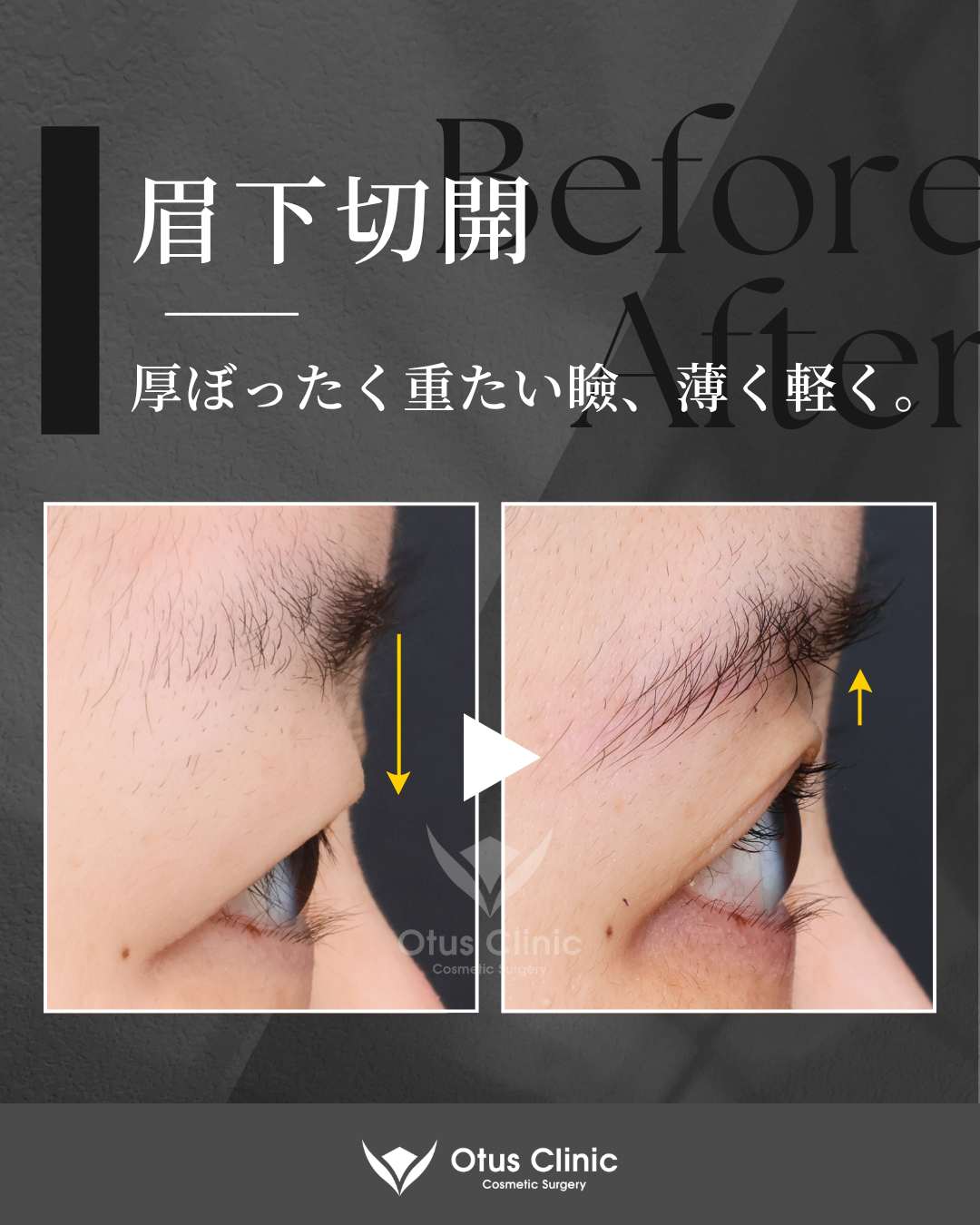 眉下切開・ROOF切除