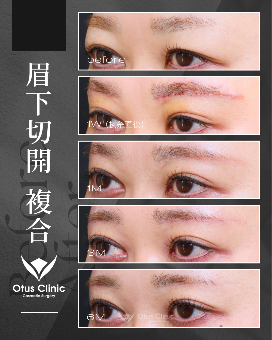 眉下切開・ROOF切除・眼窩脂肪移動