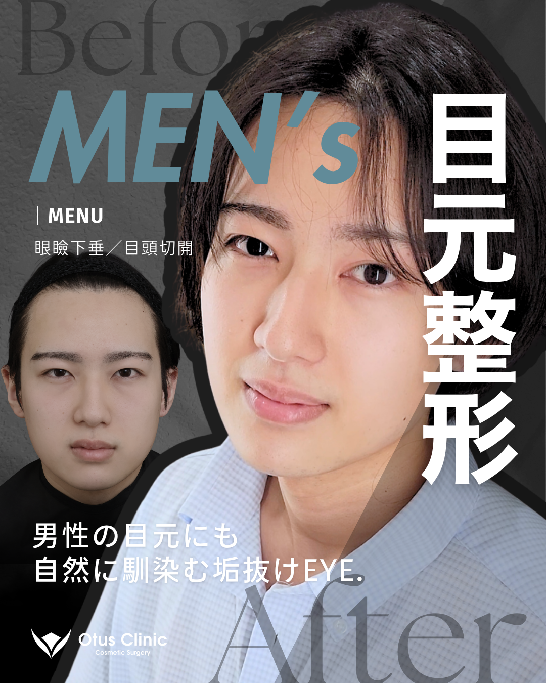 眼瞼下垂・目頭切開