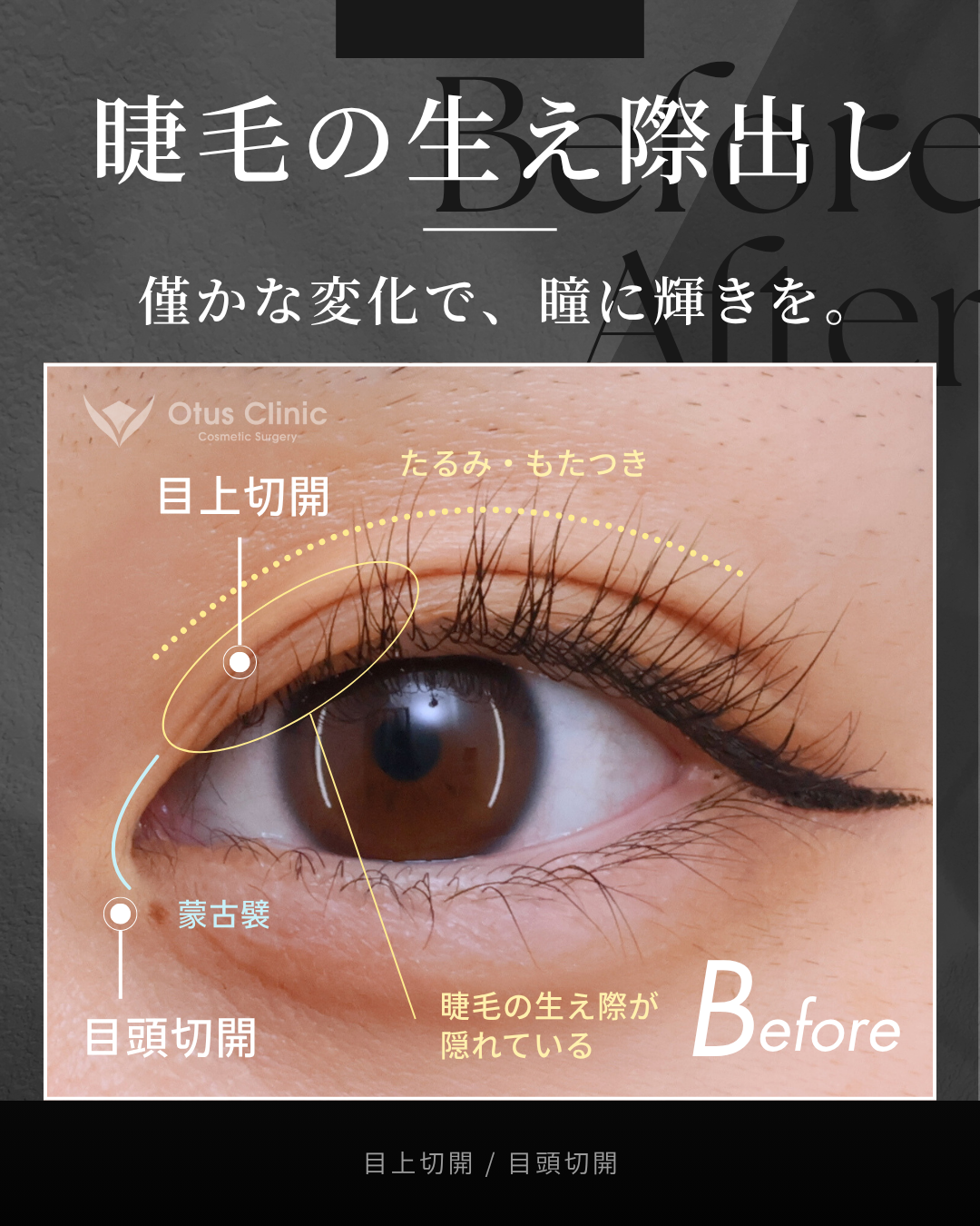 目上切開・目頭切開