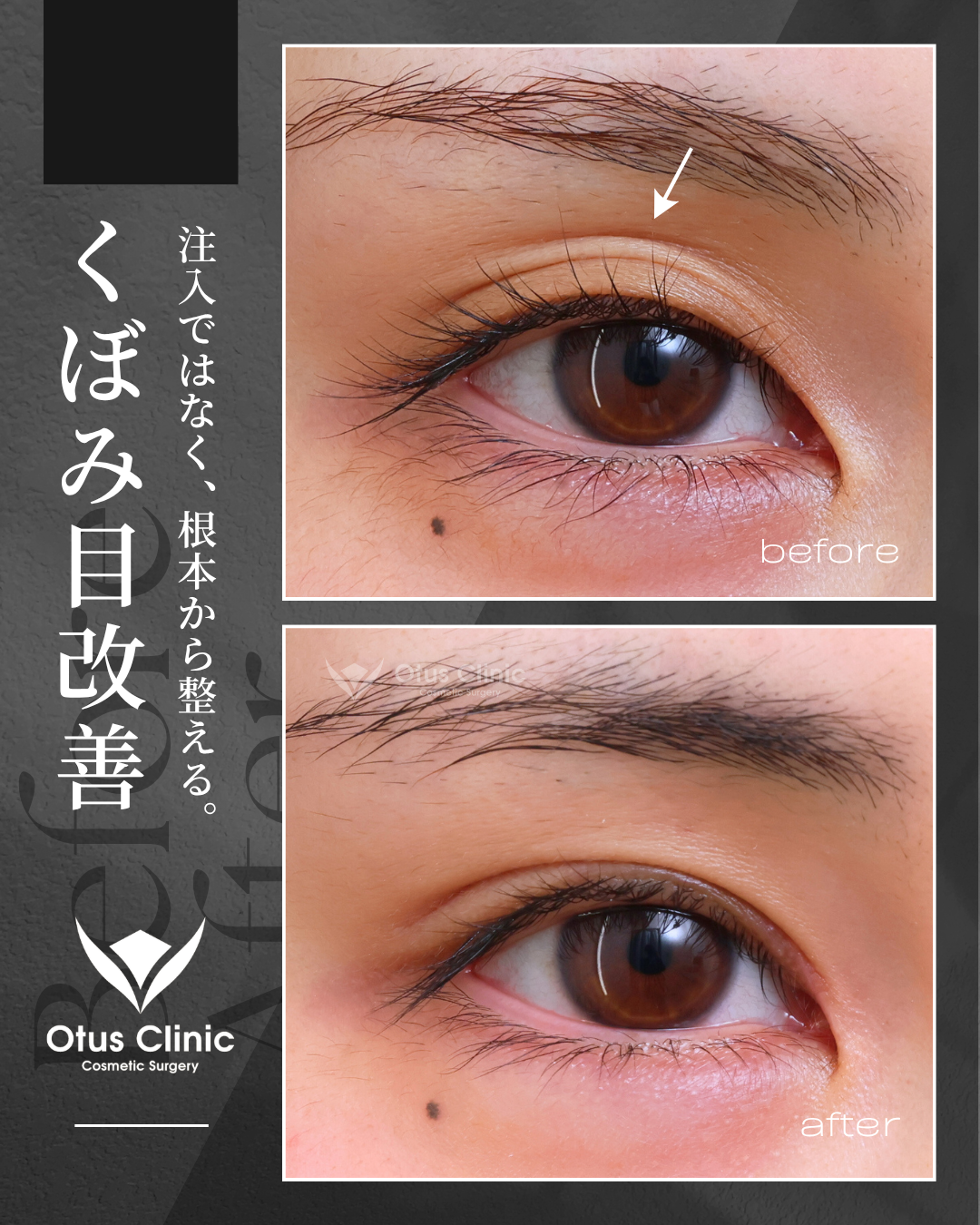 眼瞼下垂（挙筋前転法）・目上切開