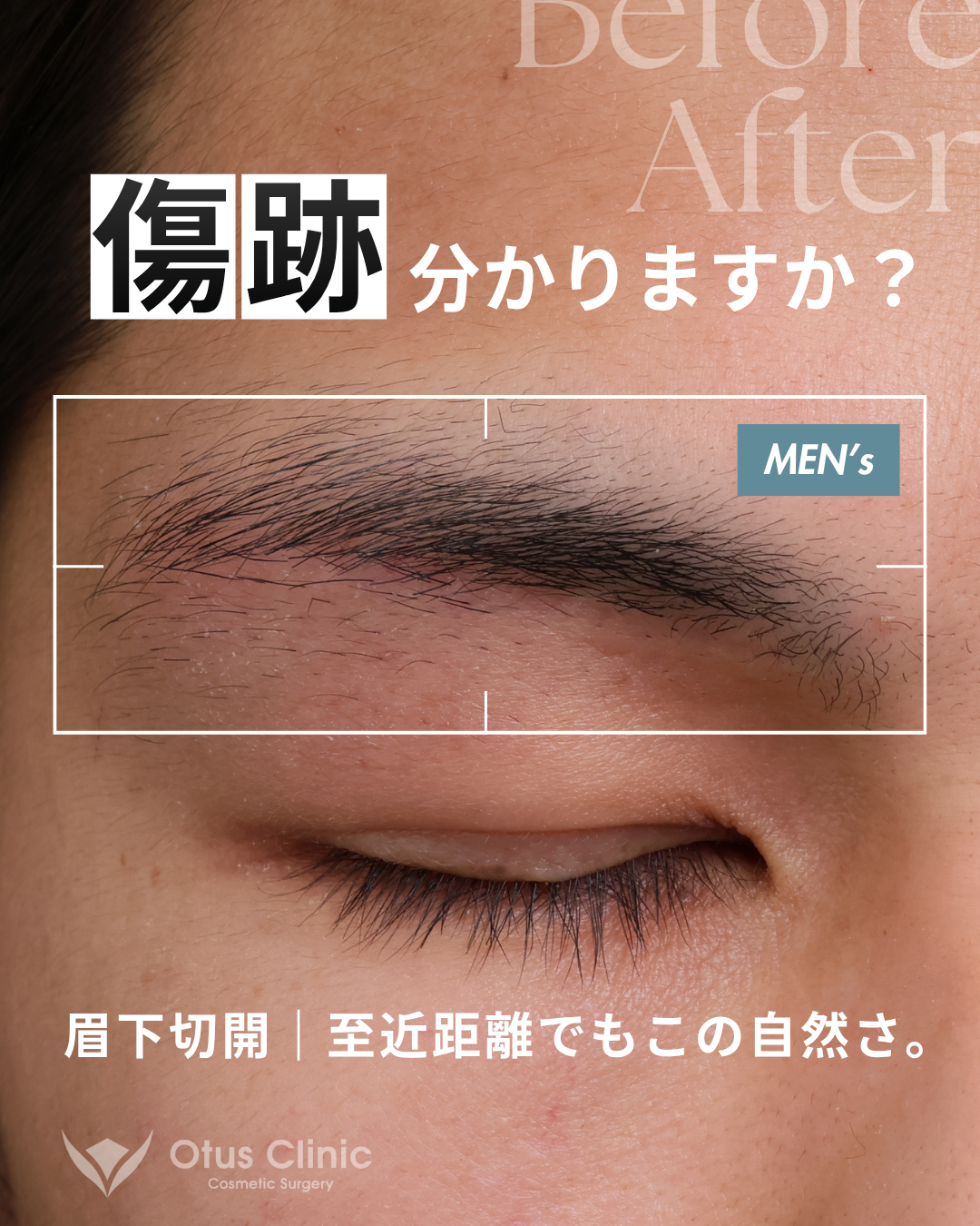 眉下切開・ROOF切除