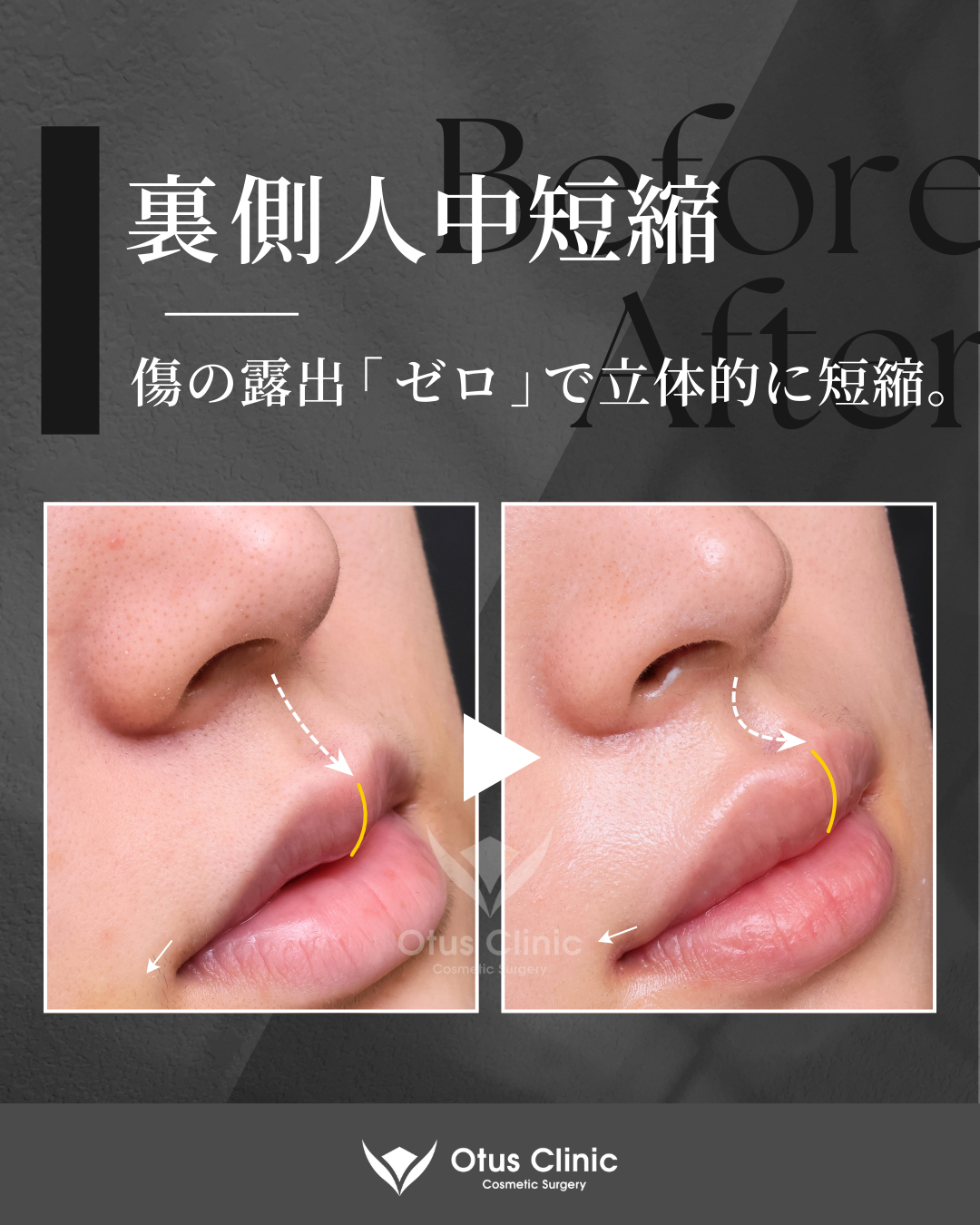 裏側人中短縮・裏側鼻翼縮小(切らない鼻翼縮小)・口角挙上・外側人中短縮