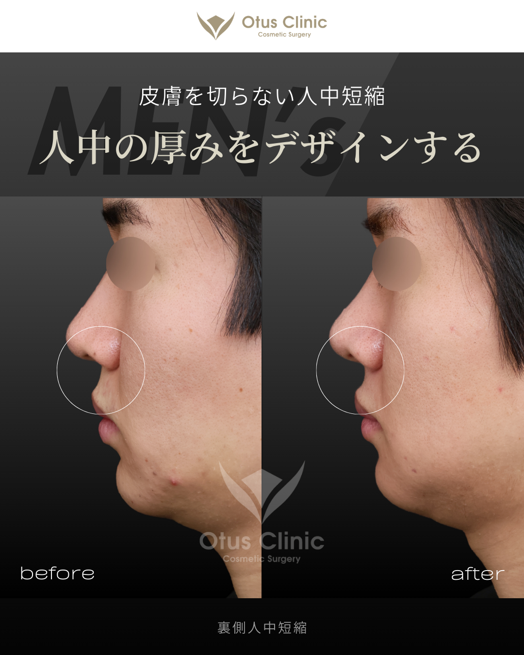 裏側人中短縮（切らない人中短縮）