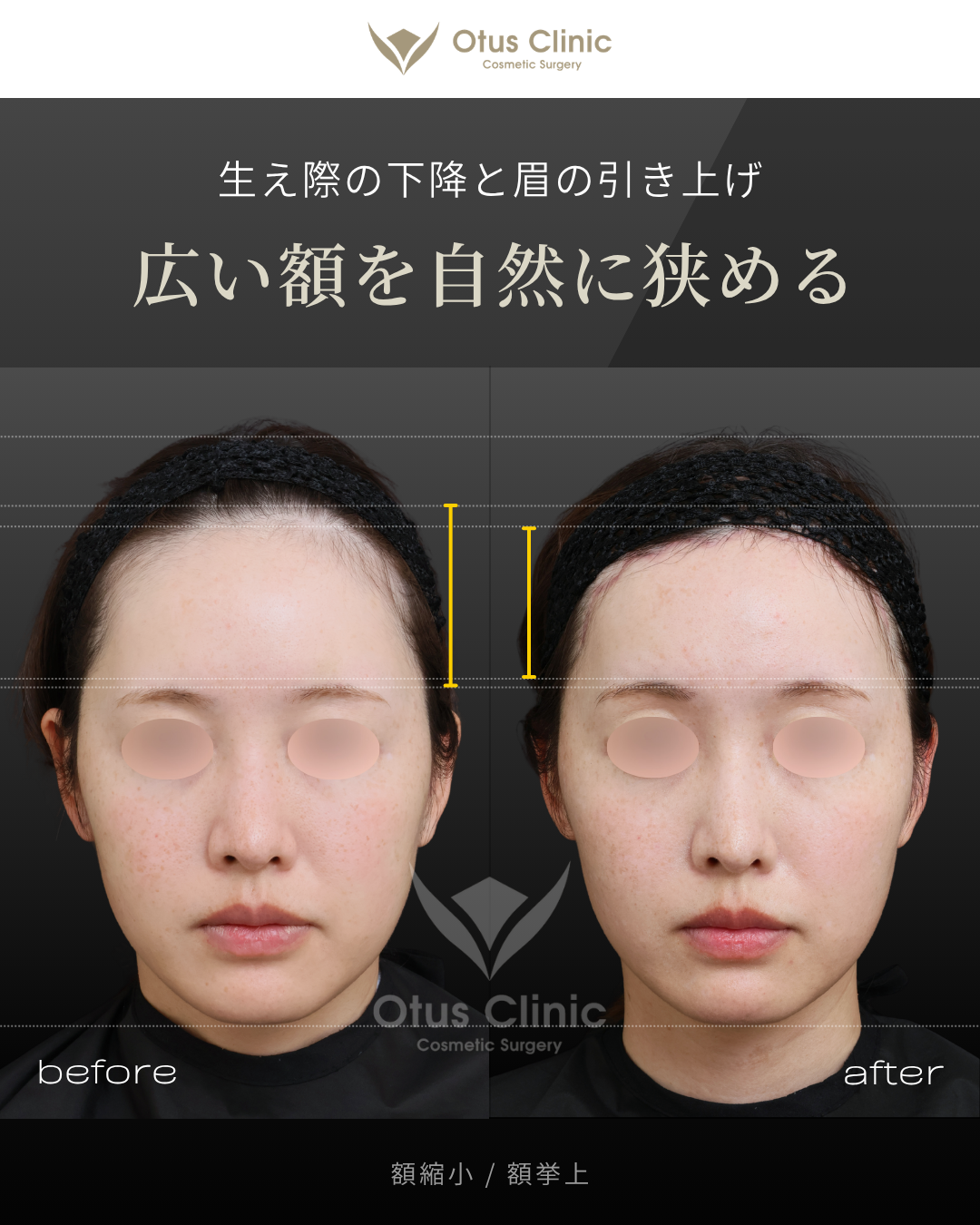 額縮小・額挙上（前額リフト）