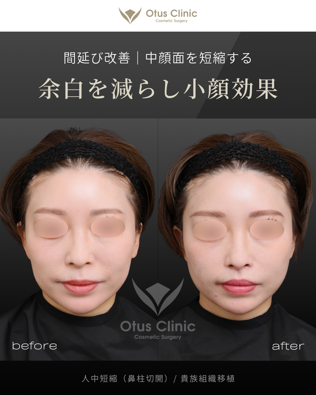 鼻柱切開人中短縮・貴族組織移植