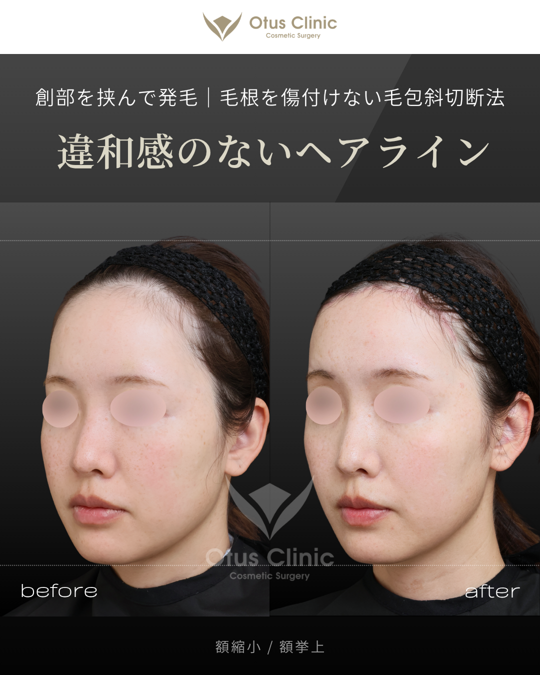 額縮小・額挙上（前額リフト）