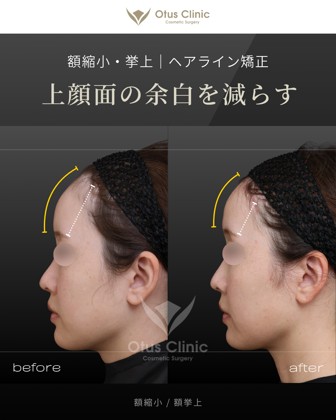 額縮小・額挙上（前額リフト）