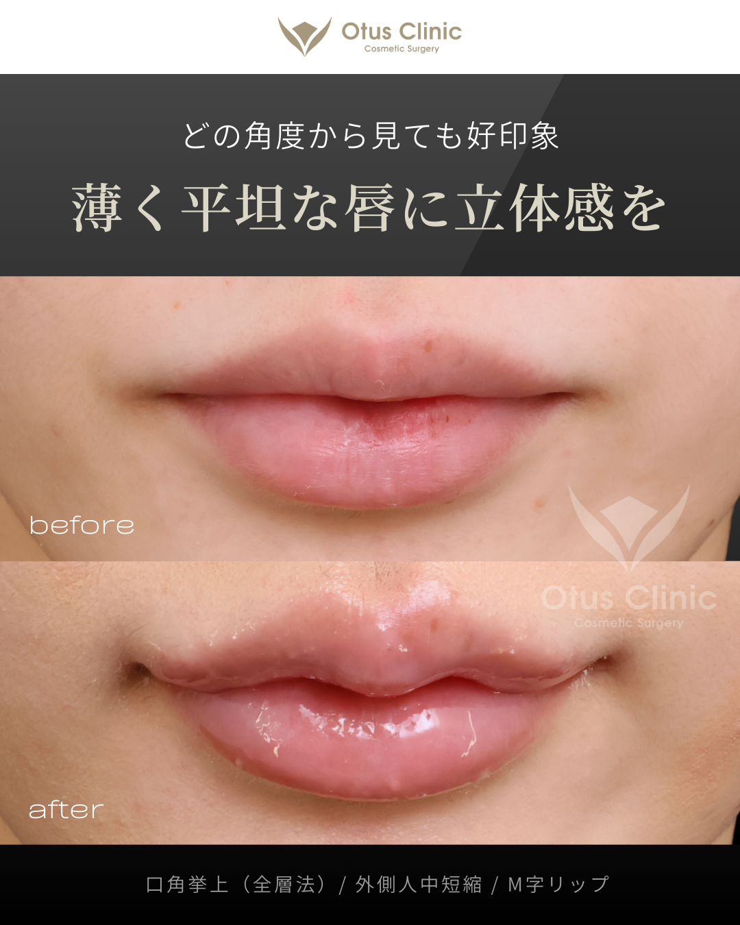 口角挙上（全層法）・外側人中短縮・M字リップ
