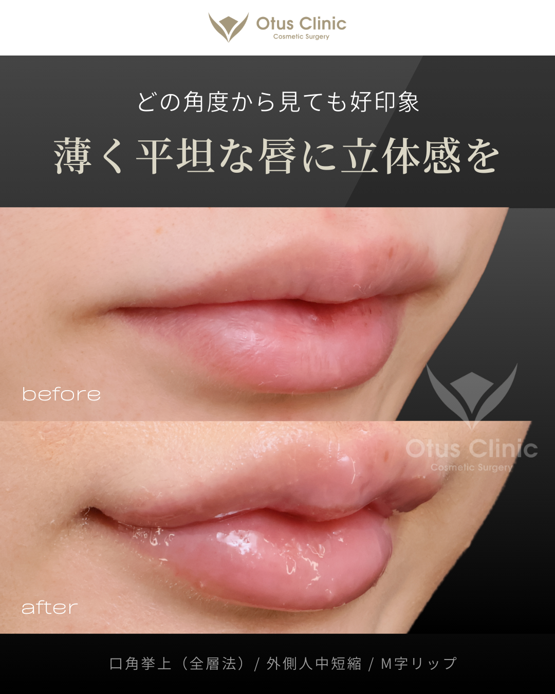 口角挙上（全層法）・外側人中短縮・M字リップ