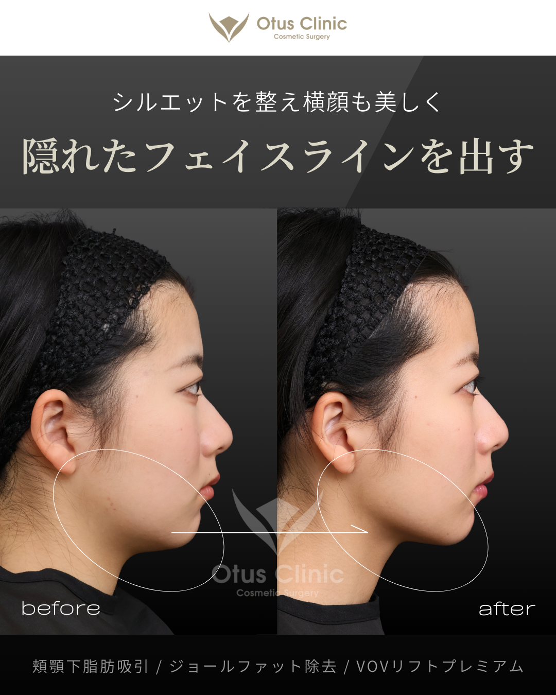 頬顎下脂肪吸引・ジョールファット除去・VOVリフトプレミアム