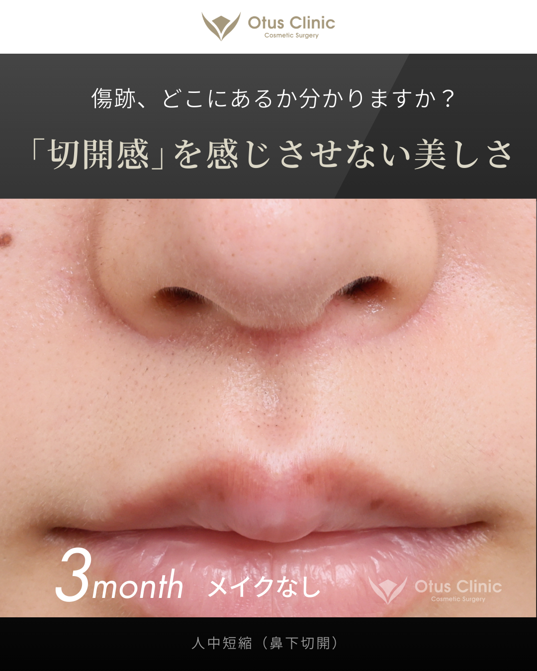人中短縮(鼻下切開)
