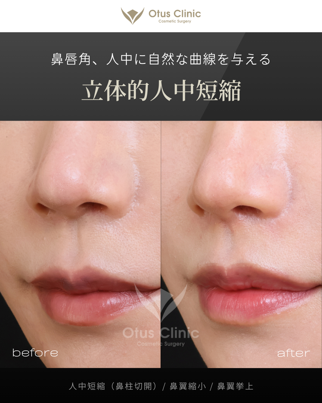 鼻柱切開人中短縮・鼻翼縮小・鼻翼挙上