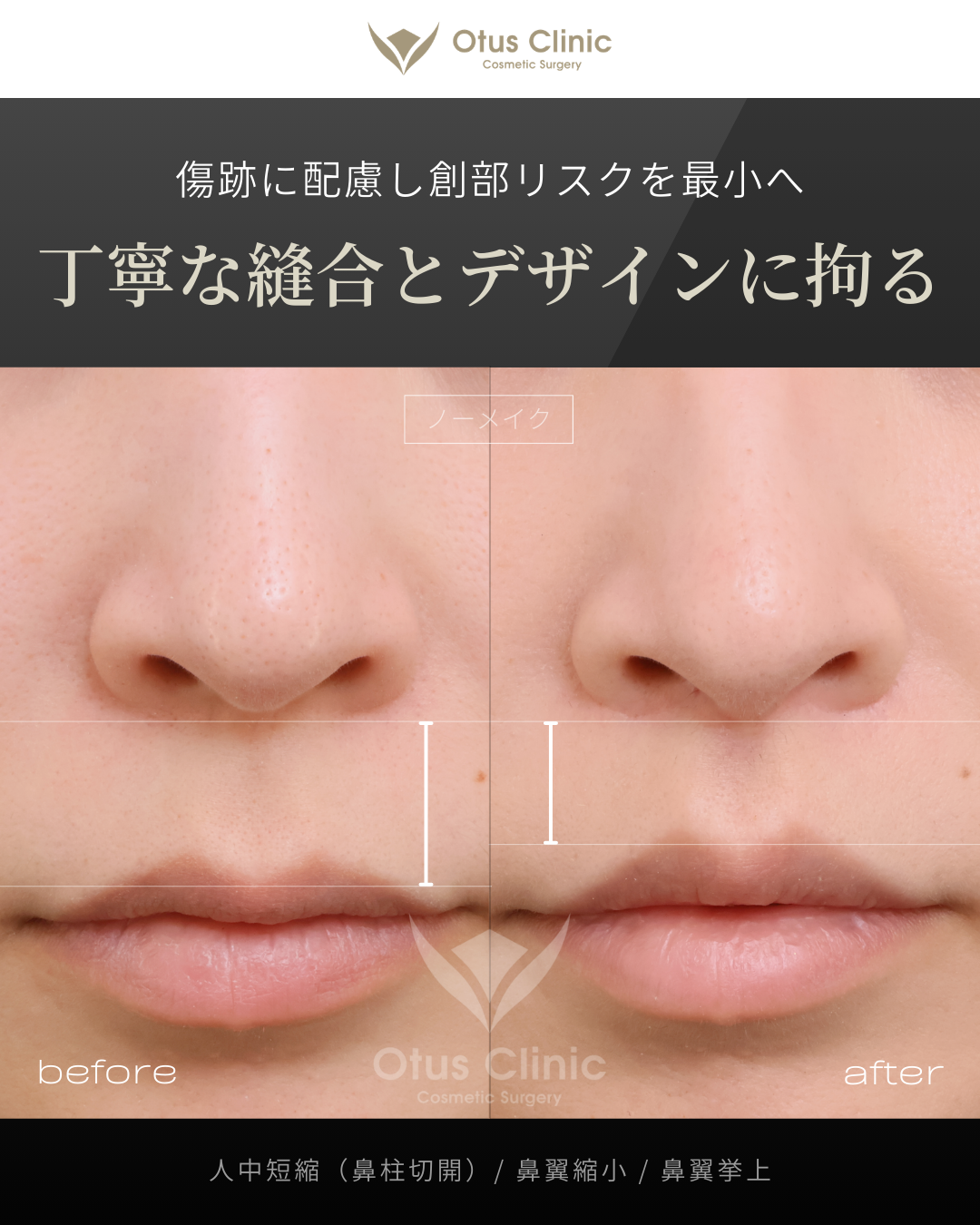 鼻柱切開人中短縮・鼻翼縮小・鼻翼挙上