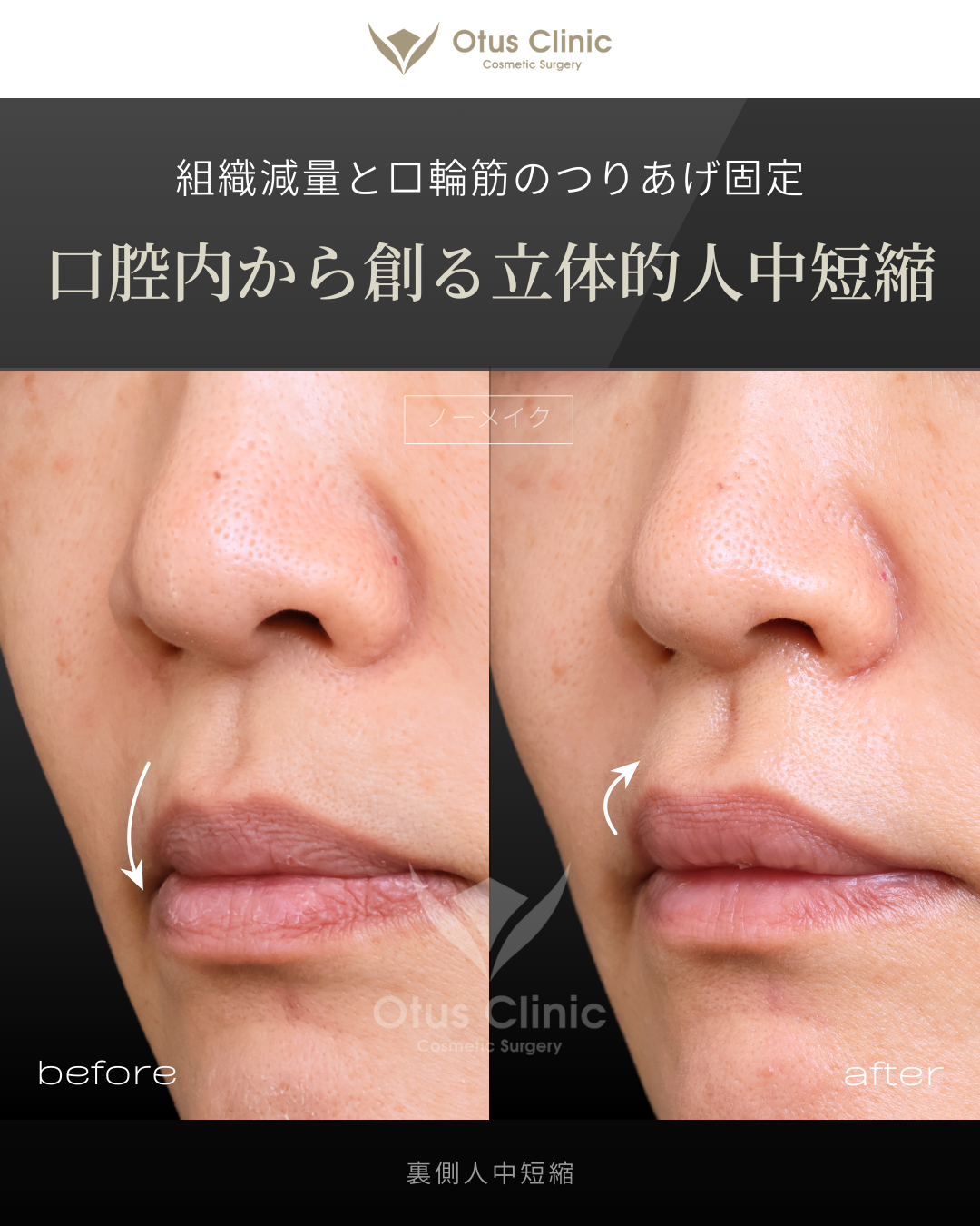 裏側人中短縮（切らない人中短縮）