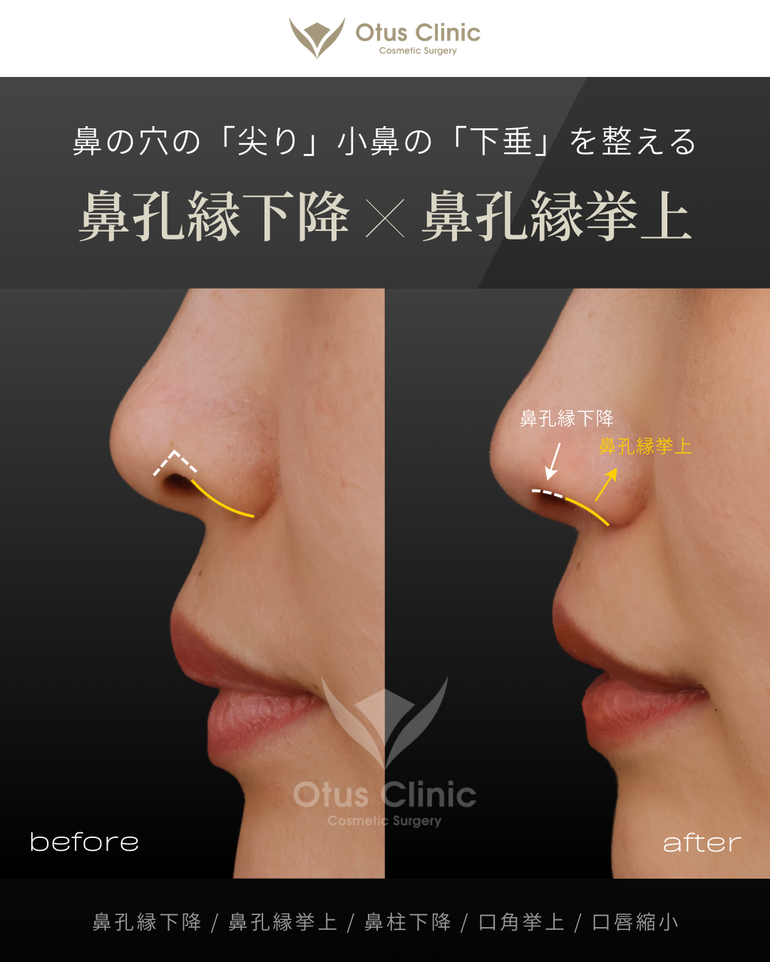 鼻孔縁下降・鼻孔縁挙上・鼻柱下降・口角挙上・口唇縮小